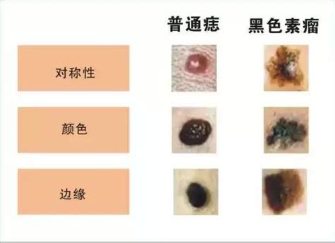 陰莖很多痣|陰囊上的痣：正常嗎？該去看皮膚科嗎？